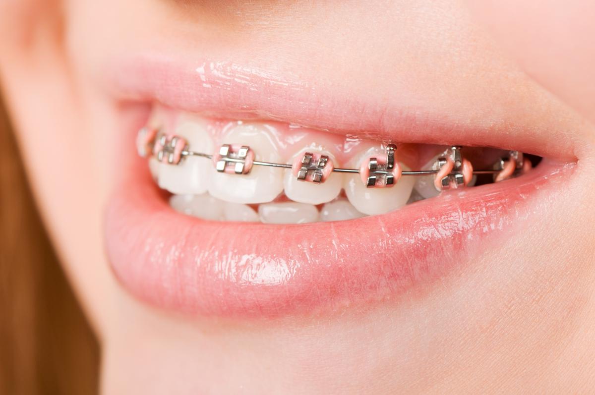 Metal Braces – The Classic & Reliable Orthodontic Solution Metal Braces – The Classic & Reliable Orthodontic Solution