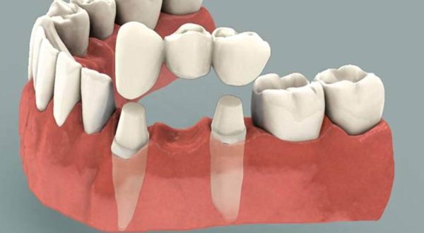 dental-bridges-1-1