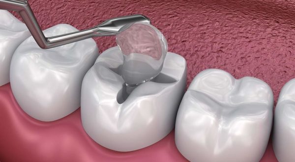 dental-fillings-1080x675