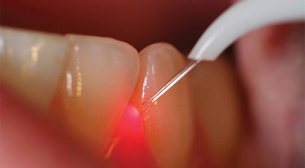 http___www.thousandoaksfamilydentistry.com_blog_2015_3_3_laser-dentistry#