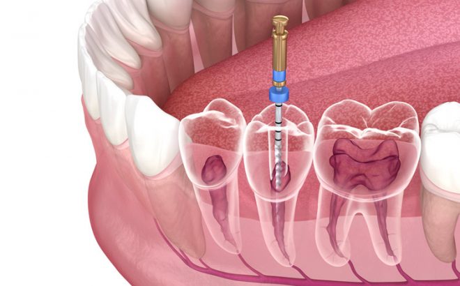 rootcanaltreatment