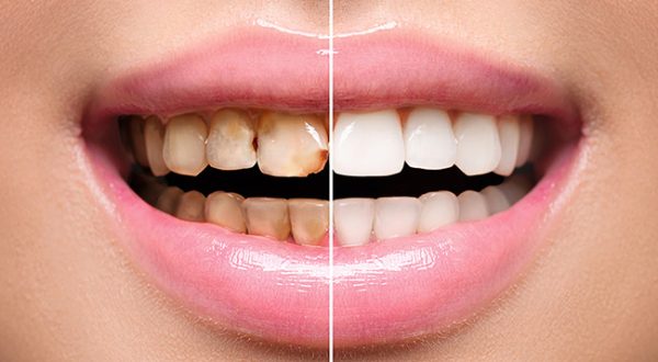 Woman Teeth before and after dental treatment. Teeth Whitening. Happy smiling woman. Dental health Concept. Oral Care, teeth restoration