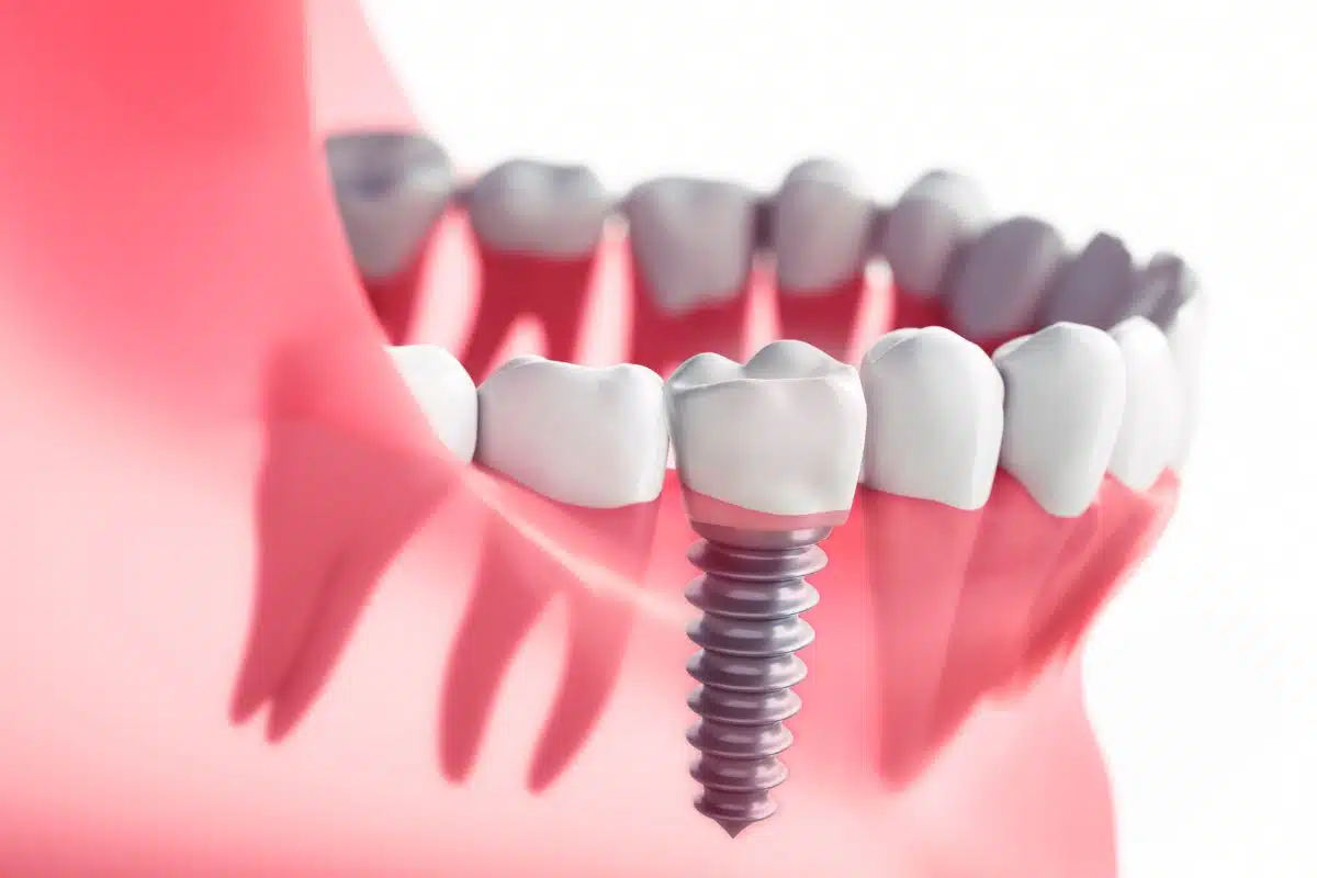 Dental Implants Dental Implants
