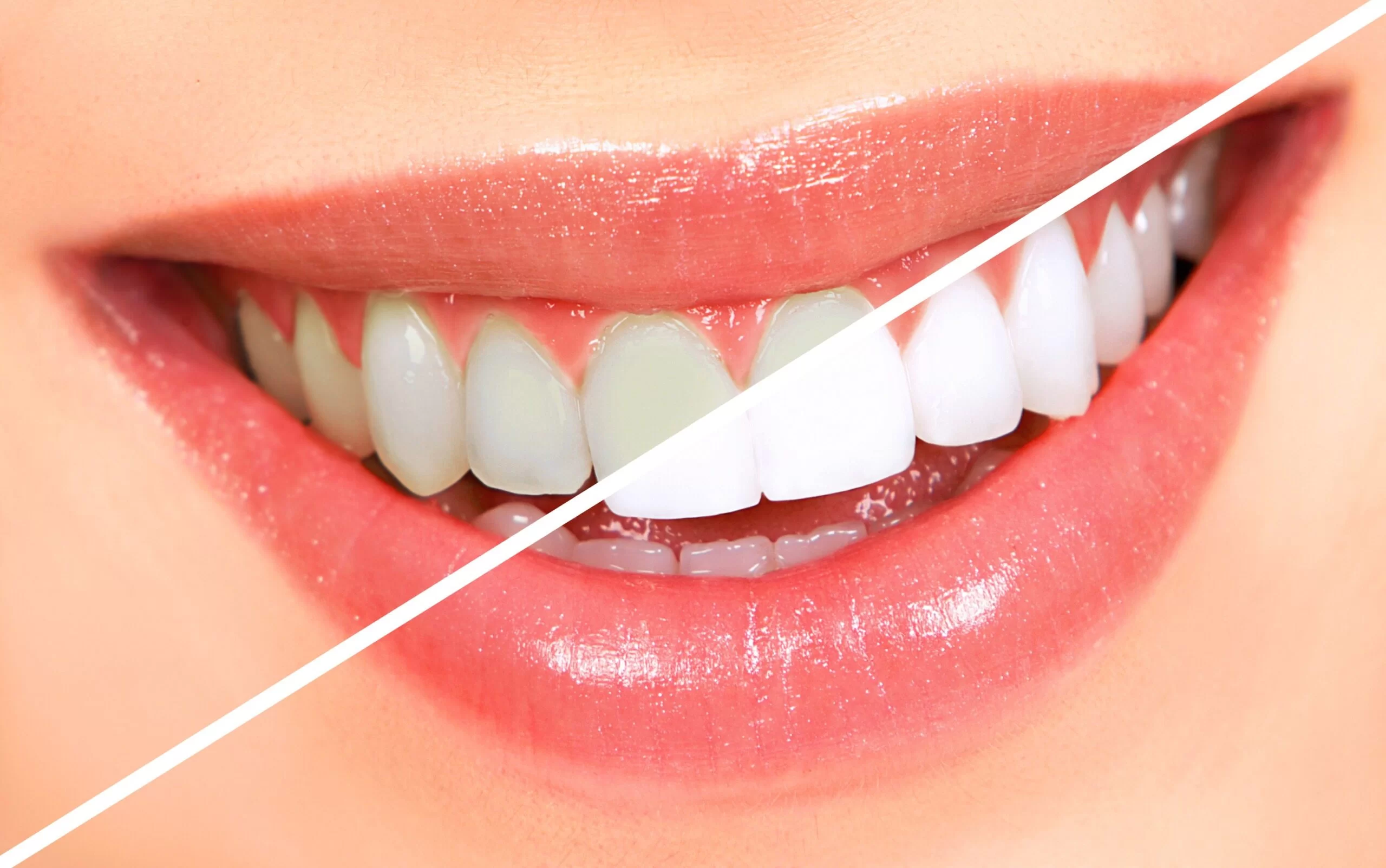 Teeth Whitening Teeth Whitening